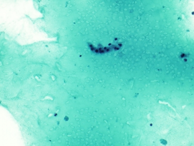 Abundant colloid and scant benign follicular cells.
