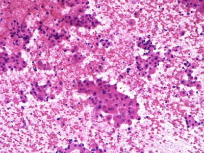 Hurthle cells: single cells and fragments.
Keywords: Hurthle Cell Adenoma, Follicular Adenoma