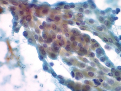 Hurthle cells (oncocytes).
Keywords: Hurthle Cell Adenoma, Folllicular Adenoma, Follicular Neoplasm