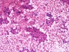 follicular_neoplasm_hurthle_cell_type-fu_hurthle_cell_adenoma-H_E4-high-sturgis.jpg