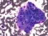 follicular_neoplasm_hurthle_cell_type-fu_hurthle_cell_adenoma-dq10-high-sturgis.jpg