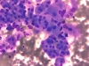 follicular_neoplasm_hurthle_cell_type-fu_hurthle_cell_adenoma-dq7-high-sturgis.jpg