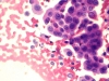 follicular_neoplasm_hurthle_cell_type-fu_hurthle_cell_carcinoma-H_E4-high-sturgis.jpg