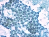 follicular_neoplasm_hurthle_cell_type-fu_hurthle_cell_carcinoma-pap4-high-sturgis.jpg