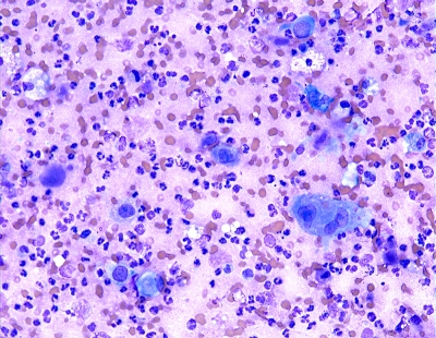 Anaplastic Carcinoma of Thyroid
Intermediate power image of anaplastic carcinoma.
Keywords: Anaplastic Carcinoma