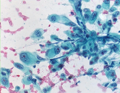 Large malignant cells.
Keywords: Undifferentiated, Anaplastic, Carcinoma