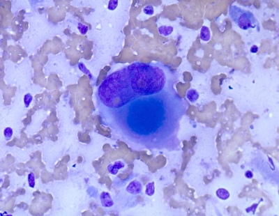 Anaplastic Carcinoma of Thyroid
Huge tumor giant cell in anaplastic carcinoma of thyoid.
Keywords: Anaplastic Carcinoma