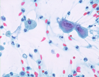 Anaplastic Carcinoma of Thyroid
Tumor giant cells 
Keywords: Anaplastic Carcinoma