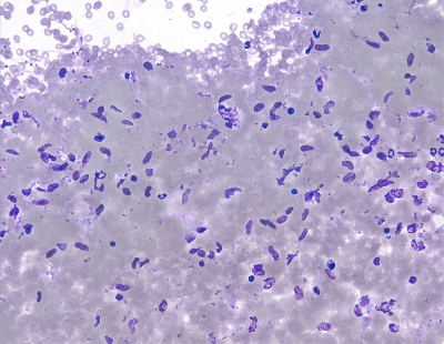 AUS/FLUS.
Numerous non-cohesive spindle cells of uncertain significance. (Histologic follow-up revealed a solitary fibrous tumour.) (Bethesda monograph, pages 38-9: scenario 9).
Keywords: SFT, Solitary Fibrous Tumor
