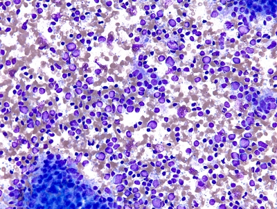 Metastatic Malt Lymphoma
Keywords: Metastatic Malt Lymphoma