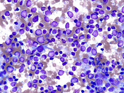 Metastatic Malt Lymphoma
Keywords: Metastatic Malt Lymphoma