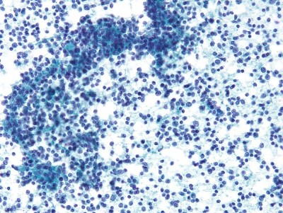 Metastatic Malt Lymphoma
Keywords: Metastatic Malt Lymphoma