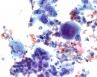 Pleomorphic malignant cells, isolated and in tissue fragments.
Keywords: Anaplastic Carcinoma