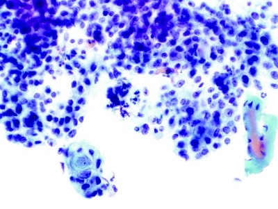 Intermediate-type cells and occasional small keratin pearl (ThinPrep).
Keywords: Primary Mucoepidermoid Carcinoma