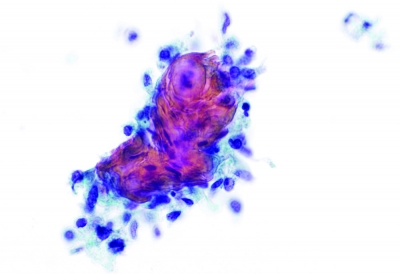 Tumor cells exhibit squamous differentiation with keratin formation (ThinPrep).
Keywords: Primary Mucoepidermoid Carcinoma