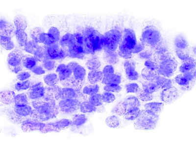 PTC, Columnar Cell Variant.
These cells are more crowded and have less cytoplasm than those of the tall cell variant.
Keywords: Papillary Carcinoma, liquid based, ThinPrep, Columnar Cell