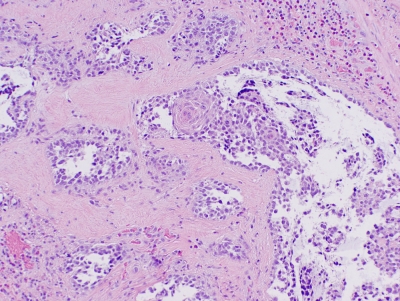 Histologic section.
Keywords: Primary Mucoepidermoid Carcinoma of Thyroid Histology