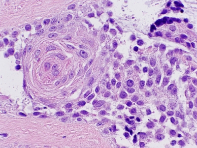 Histologic section.
Keywords: primary Mucoepidermoid Carcinoma of Thyroid Histology