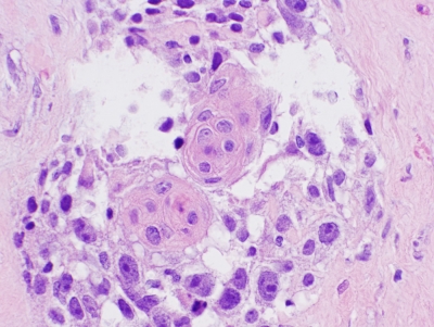 Histologic section.
Keywords: Primary Mucoepidermoid Carcinoma of Thyroid Histology