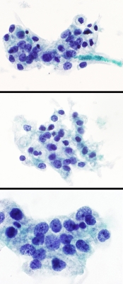 Metastatic renal cell carcinoma (ThinPrep).
Keywords: RCC, Renal Cell Carcinoma, Metastatic Carcinoma
