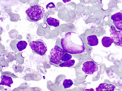 Diffuse large B cell lymphoma.
Keywords: Diffuse large B cell lymphoma, NHL, Non-hodgkin lymphoma