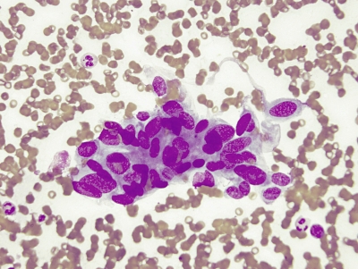 Oval, elongated, overlapping nuclei.
Keywords: Papillary Carcinoma, Overlapping Nuclei