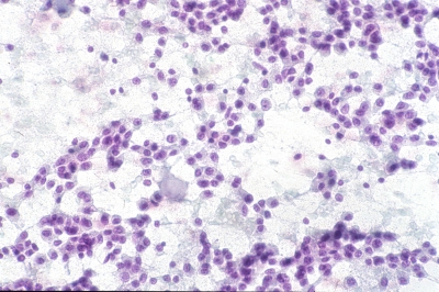 Monomorphic population of plasmacytoid cells with amyloid.
Keywords: Medullary, Carcinoma, 