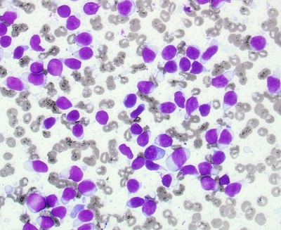 Lymphocytes in Chronic Lymphocytic Thyroiditis (Hashimoto's) High Power
High power view of reactive lymphocytes in Chronic Lymphocytic Thyroiditis (Hashimoto's). Note the smudged chromatin, slight irregularity of nuclear profiles and variable amount of basophilic cytoplasm consistent with reactive lymphocytes
Keywords: Lymphocytes Chronic Lymphocytic Thyroiditis (Hashimoto's)