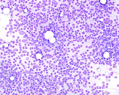 Pure population of Lymphocytes on FNA in Chronic Lymphocytic Thyroiditis (Hashimoto's)
At times an FNA of Chronic Lymphocytic Thyroiditis (Hashimoto's) may yield a pure population of lymphocytes and is a clue to the disorder.
Keywords: Lymphocytes Chronic Lymphocytic Thyroiditis (Hashimoto's)