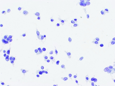 Poorly Differentiated Carcinoma (Insular Carcinoma).
Isolated malignant cells (ThinPrep®).
Keywords: Insular Carcinoma, Poorly Differentiated Carcinoma