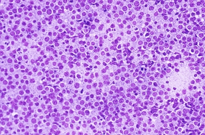 Diffuse large B cell lymphoma.
Keywords: Non-Hodgkin Lymphoma, Malignant
