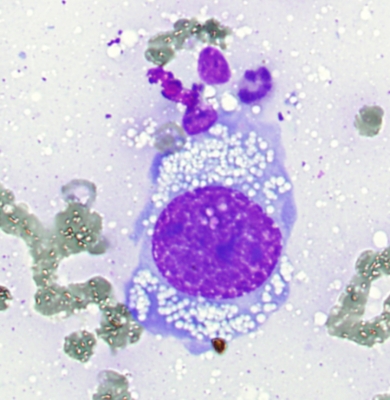 Breast Carcinoma Metastatic to Thyroid
