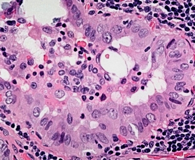 Papillary Thyroid Carcinoma - Tall Cell Variant
By definition, the cells of the tall cell variant are three or more times longer than they are wide (histologic specimen).
Keywords: Papillary Carcinoma, Tall Cell Variant, PTC Tall Cell