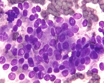 Papillary Carcinoma of Thyroid - Tall Cell Variant
Features of papillary carcinoma, overlapping nuclei, internuclear pseudoinclusions are readily found.
Keywords: Papillary Thyroid Carcinoma, Tall Cell Variant (PTC TCV): 