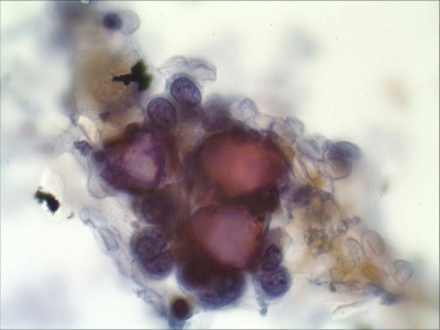 Psammoma bodies.
Keywords: Papillary Carcinoma, Classic, Psammoma Body