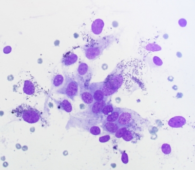 Reactive Cyst Lining Cells with Hemosiderin Pigment
Keywords: Reactive Cyst Lining Cells with Hemosiderin Granuleshronic Lymphocytic Thyroiditis (Hashimoto) Reparative follicular epithelium
