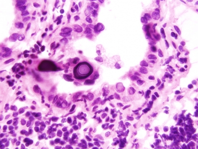 Papillary Carcinoma of Thyroid-Frozen Section
Psammoma Body in Papillary Carcinoma.
Keywords: Papillary Carcinoma, Frozen Section, Psammoma Body