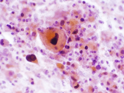 Squamous Cell Carcinoma of the Thyroid.
Keratinizing malignant cells with necrosis.
Keywords: Squamous Cell Carcinoma, Keratinizing