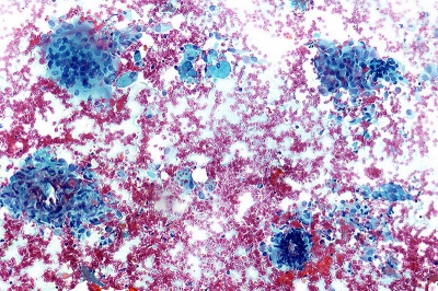 Numerous granulomas and multinucleated histiocyte (upper left).
Keywords: Granulomatous (subacute) thyroiditis