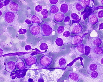 Plasmacytoid B-Cell Lymphoma in Thyroid FNA
Plasmacytopid B-Cell Lymphoma in Thyroid FNA
Keywords: B-Cell Lymphoma Plasmacytoid