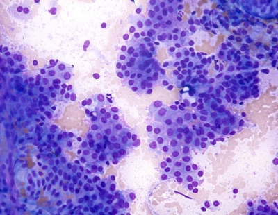 Graves' disease: monolayered sheets with subtle flame cells.
Keywords: Benign Follicular Nodule, BFN, Graves disease