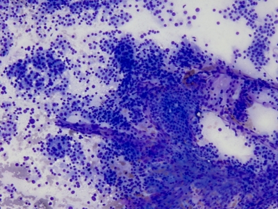 Very cellular specimen with numerous microfollicles and minimal colloid.
Keywords: Follicular Neoplasm