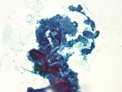 Branching papillae and monolayered sheets.
Keywords: Papillary Carcinoma with Powdery Chromatin