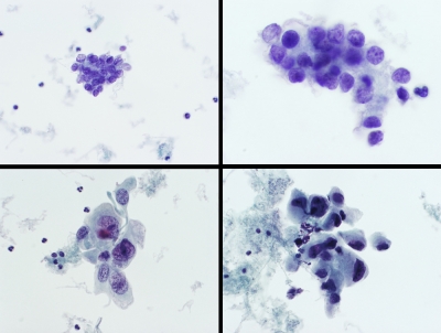 Mixed papillary carcinoma (upper images) and anaplastic carcinoma (lower images) (ThinPrep).
Keywords: Carcinoma with Mixed Features, anaplastic, papillary