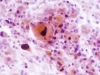 Squamous_cell_CA_of_thyroid_b.jpg