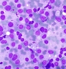Thy_FNA_Plasmacytoid_B-cell_lymphoma3_DQ_SM.jpg