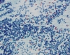 chronic_Lymphocytic_thyroiditis-predominantly_mature_lymphocytes_with_no_Hurthle_cells-_Pap-low-crothers.jpg