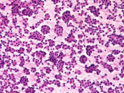Hurthle Cell Neoplasm - Hurthle cells (low magnification). - IMAGE ATLAS