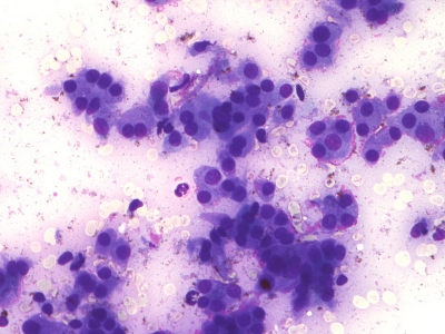 Hurthle cells (oncocytes).
Keywords: Hurthle Cell Adenoma, Follicular Adenoma