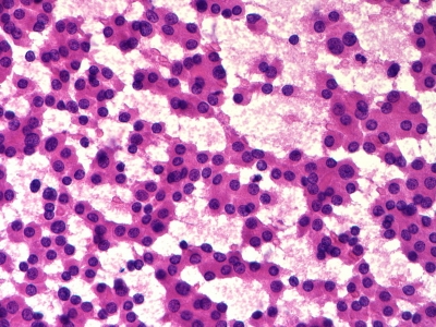 Hurthle cells (oncocytes).
Keywords: Hurthle Cell Adenoma, Folllicular Adenoma, Follicular Neoplasm